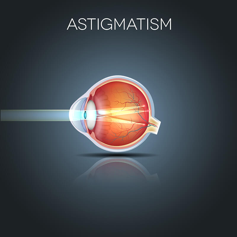 Chart Showing How Astigmatism Affects the Eye