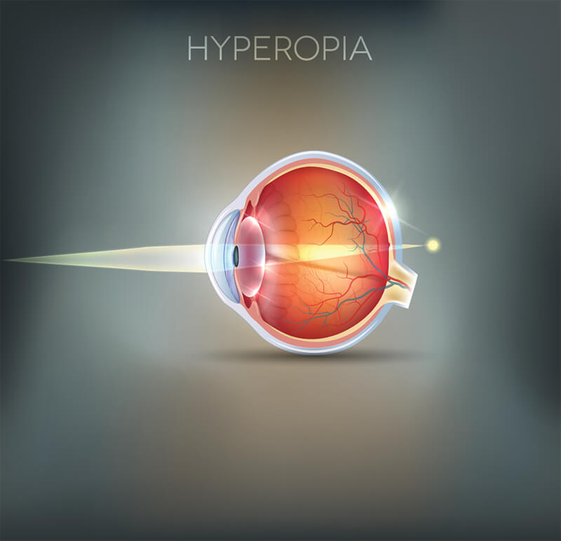 Chart Showing How Hyperopia Affects the Eye