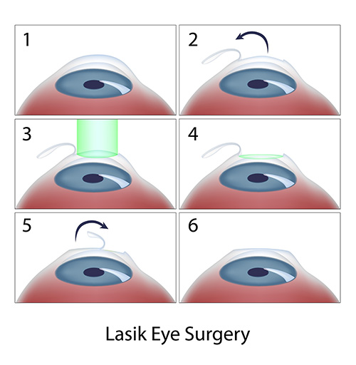 lasik eye surgery diagram