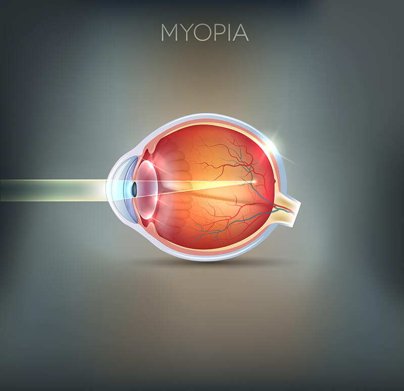 Chart Showing How Myopia Affects the Eye