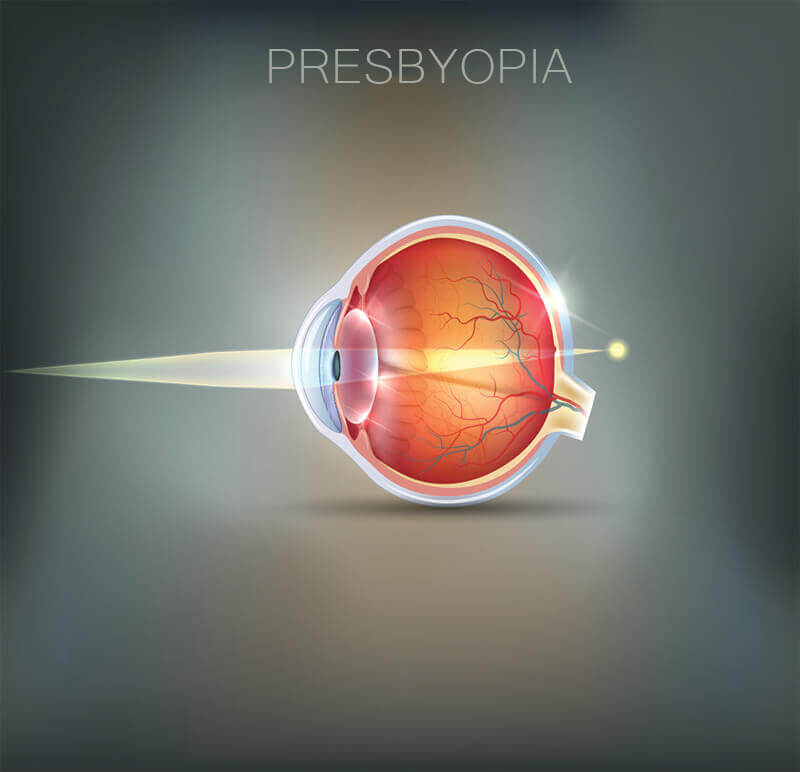 Chart Showing How Presbyopia Affects the Eye