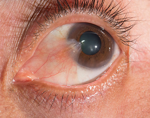 Closeup of Pterygium in an Eye